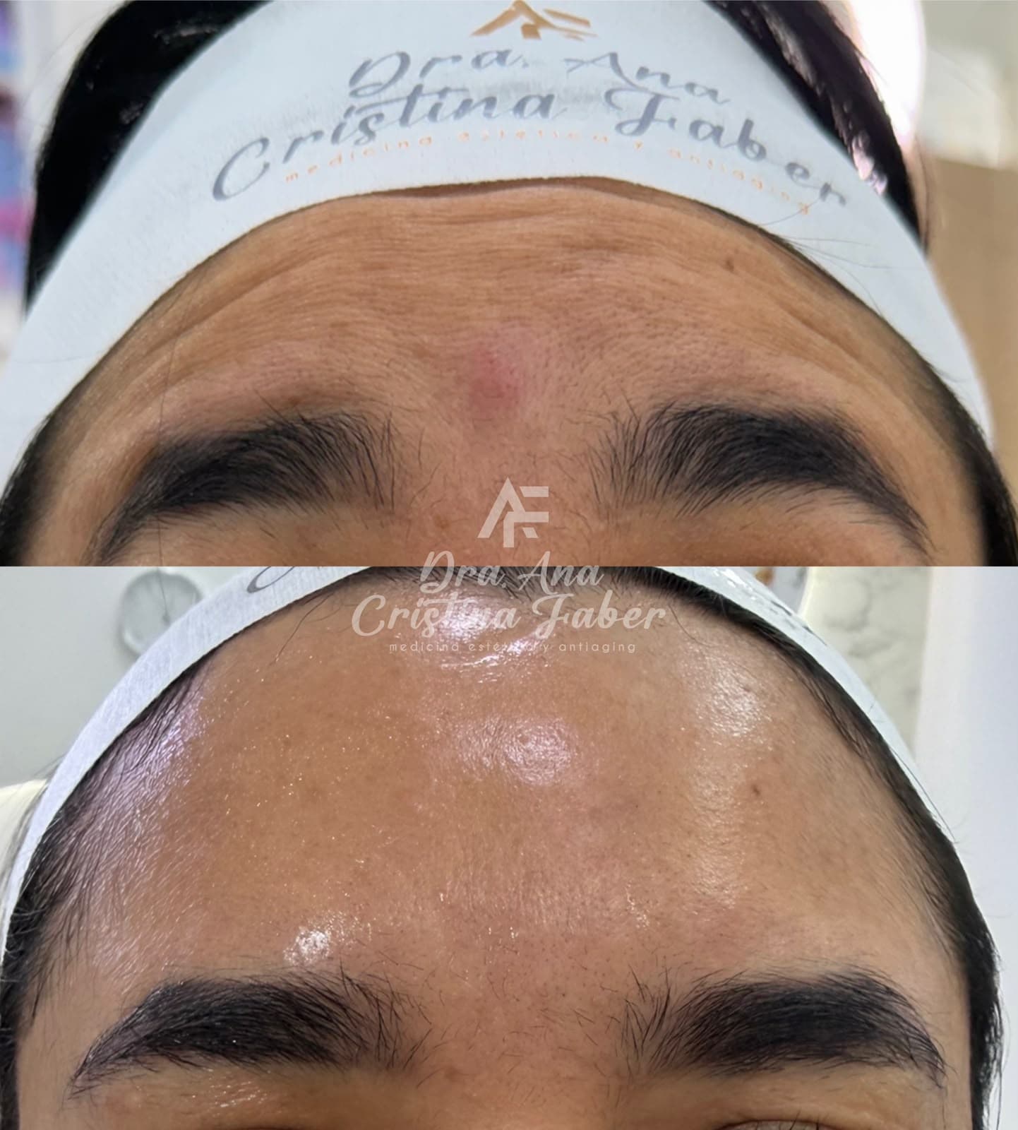 Antes y después tratamiento facial — Dra. Ana Cristina Faber, medicina estética Cali