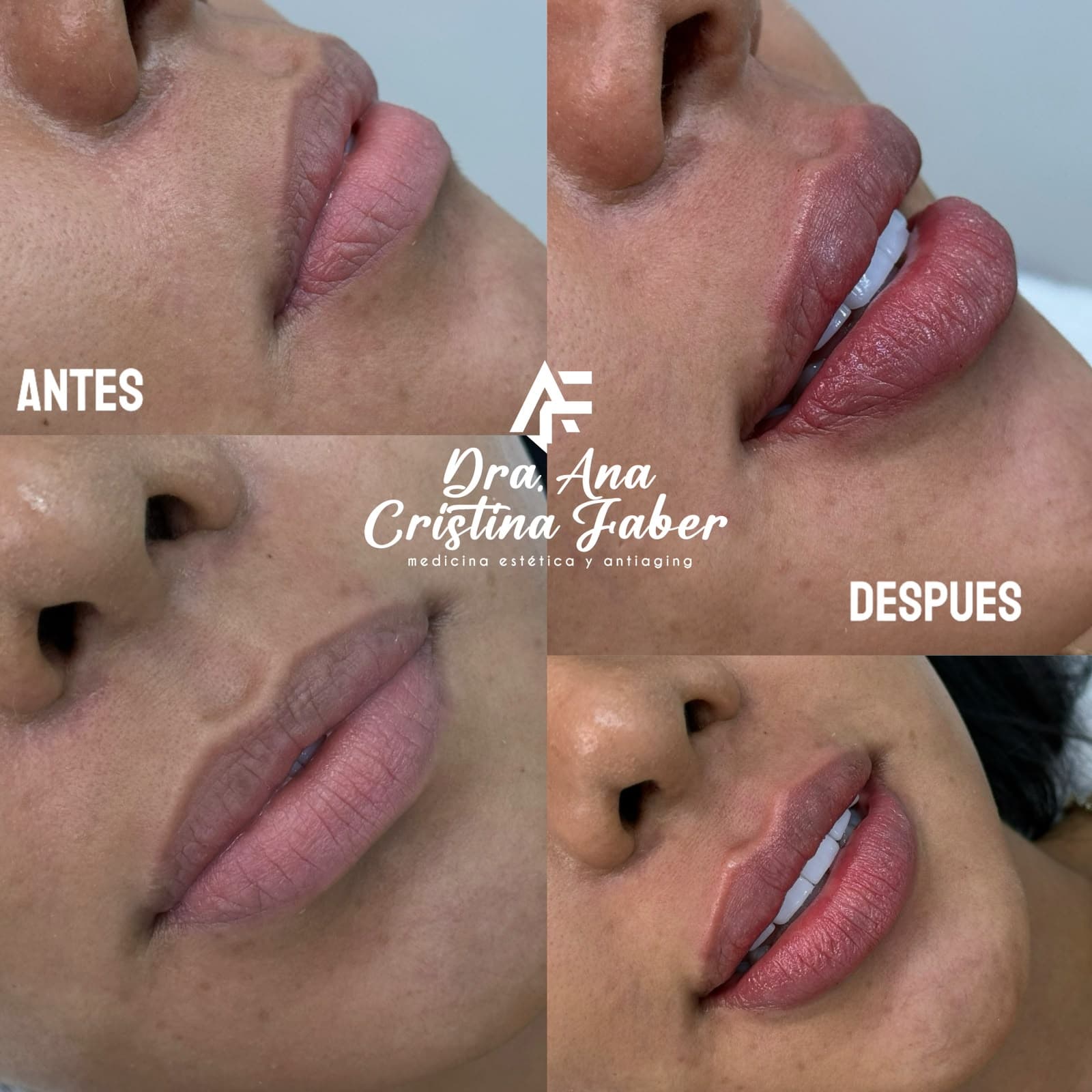 Antes y después perfilamiento de labios con ácido hialurónico — Dra. Ana Faber Cali