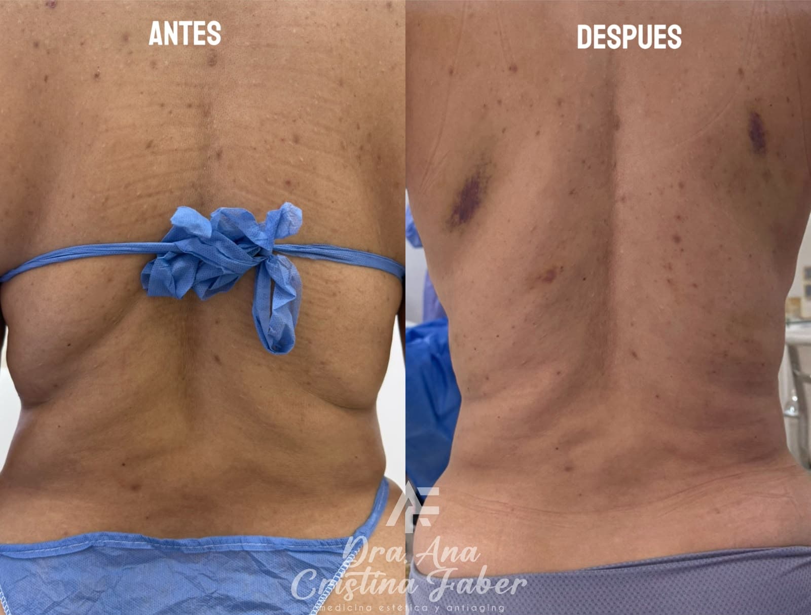 Antes y después tratamiento corporal estético — Dra. Ana Cristina Faber Cali