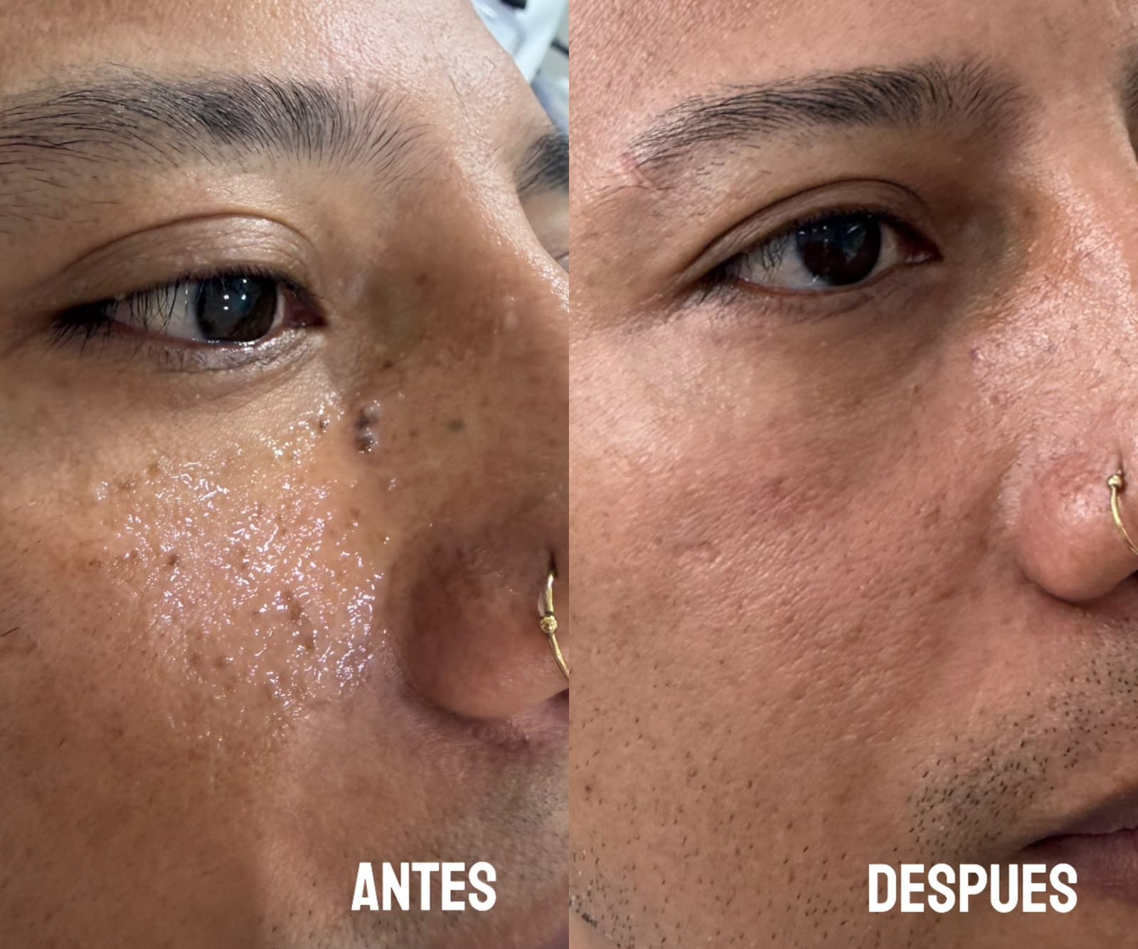 Antes y después renovación cutánea y rejuvenecimiento facial — Dra. Ana Faber Cali